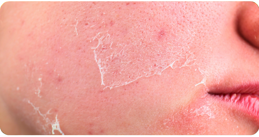 Jak zlepšit pleť v chladném období (AjemFIT blog)